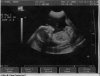 baby2_ultrasound_2.JPG